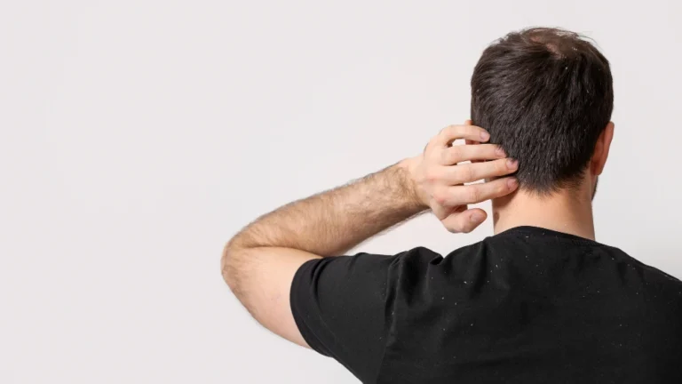 Close-up of dandruff flakes on black fabric — dandruff, seborrheic dermatitis & shedding