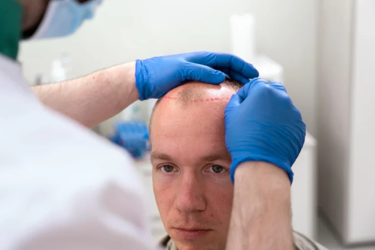 DHI vs FUE: surgeon making preoperative hairline markings on patient’s scalp