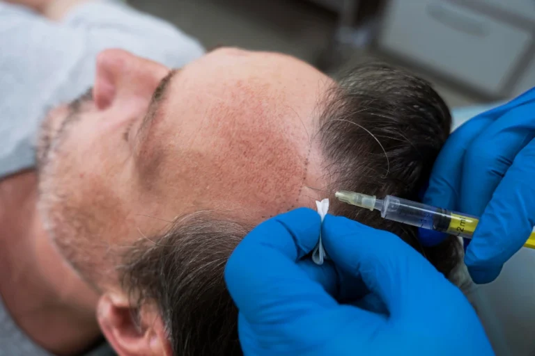 Patient receiving local anesthesia for a hair transplant with vital signs monitoring